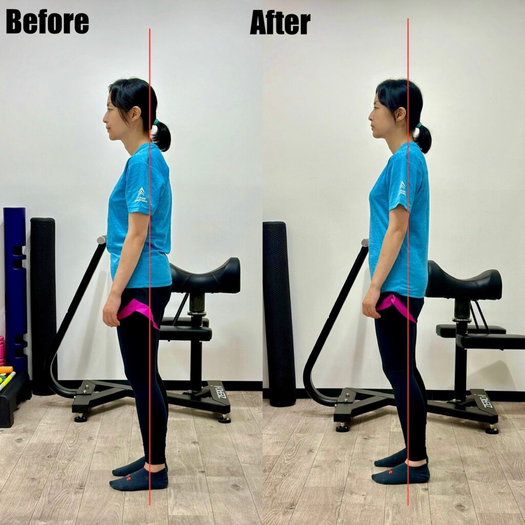 姿勢改善前後の比較写真。首と背中のラインが整った様子